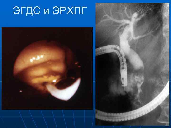 ЭГДС и ЭРХПГ 