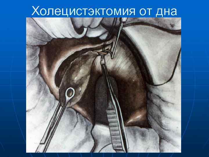 Холецистэктомия от дна 
