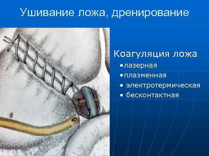 Ушивание ложа, дренирование Коагуляция ложа • лазерная • плазменная • электротермическая • бесконтактная 