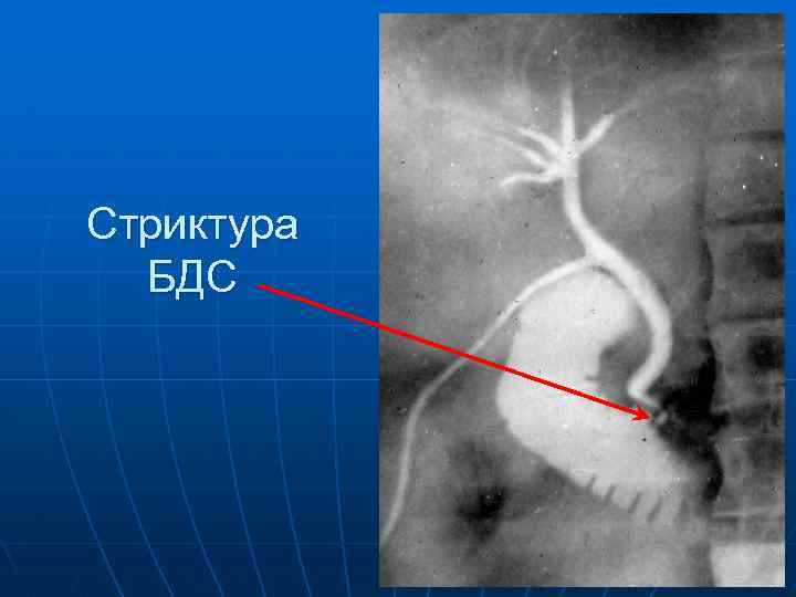 Стриктура БДС 