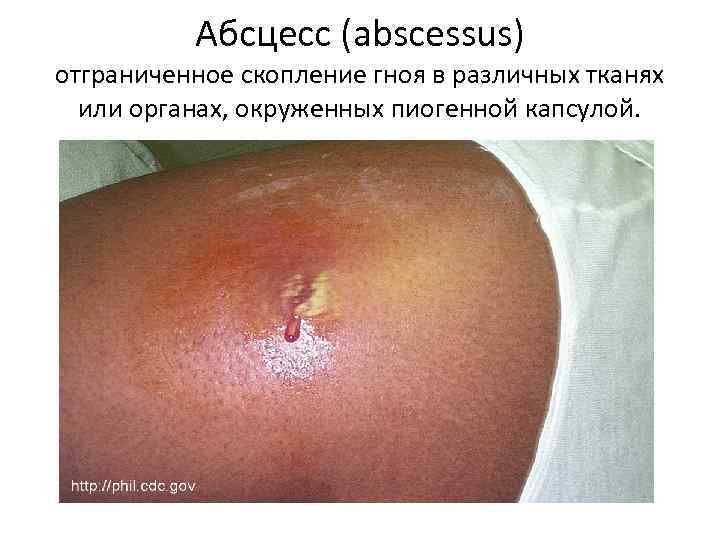 Абсцесс (abscessus) отграниченное скопление гноя в различных тканях или органах, окруженных пиогенной капсулой. 