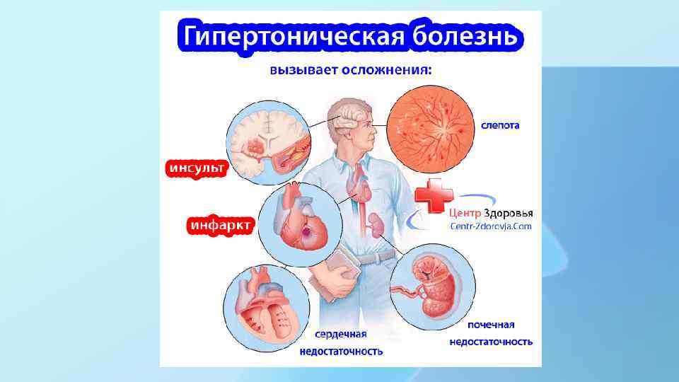 Гипертоническая болезнь рисунок