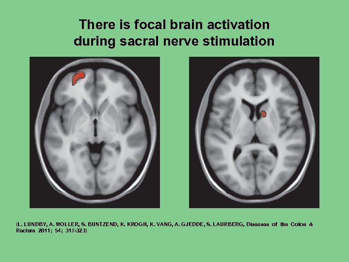 There is focal brain activation during sacral nerve stimulation (L. LUNDBY, A. MOLLER, S.