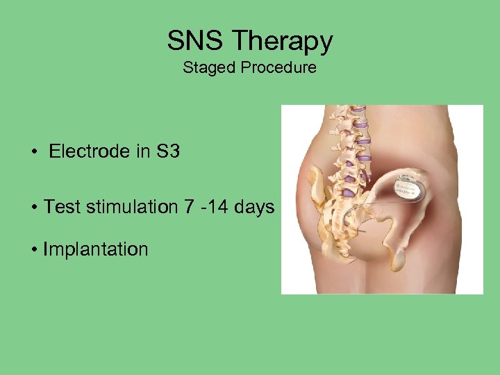 SNS Therapy Staged Procedure • Electrode in S 3 • Test stimulation 7 -14