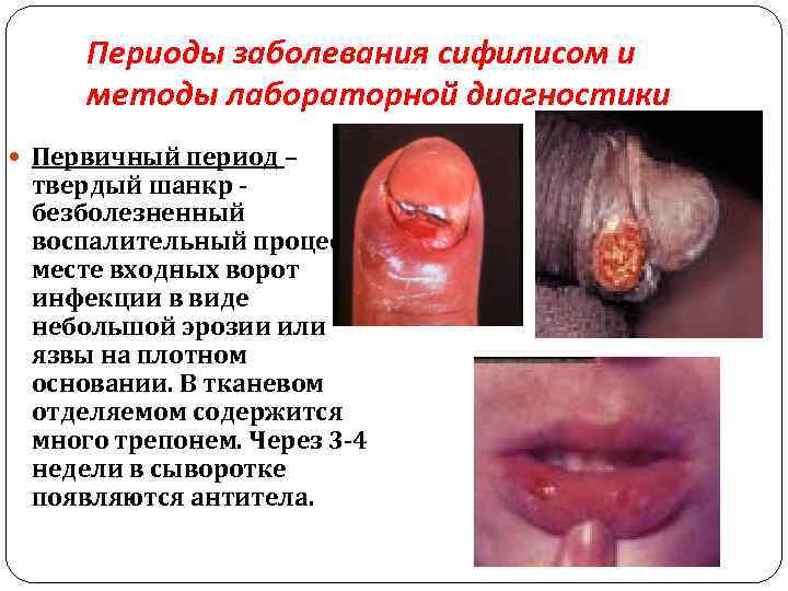 Периоды заболевания сифилисом и методы лабораторной диагностики Первичный период – твердый шанкр - безболезненный