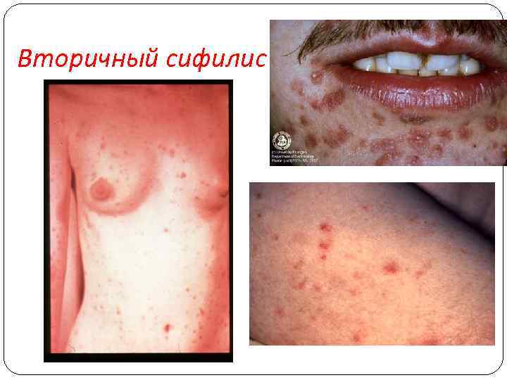 Вторичный сифилис 