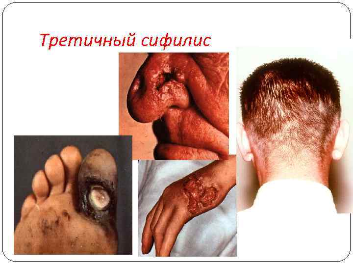 Третичный сифилис 