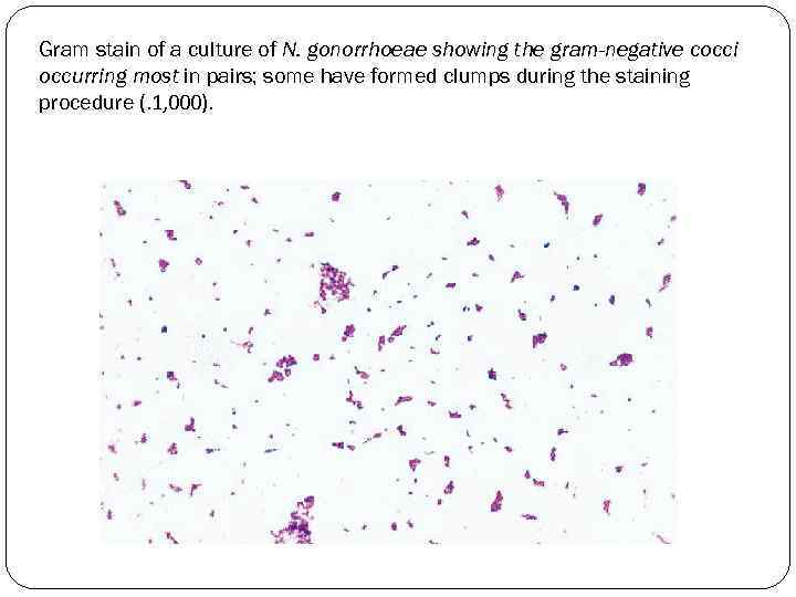 Gram stain of a culture of N. gonorrhoeae showing the gram-negative cocci occurring most