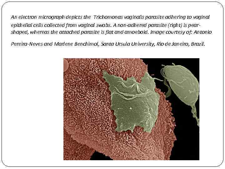 An electron micrograph depicts the Trichomonas vaginalis parasite adhering to vaginal epithelial cells collected