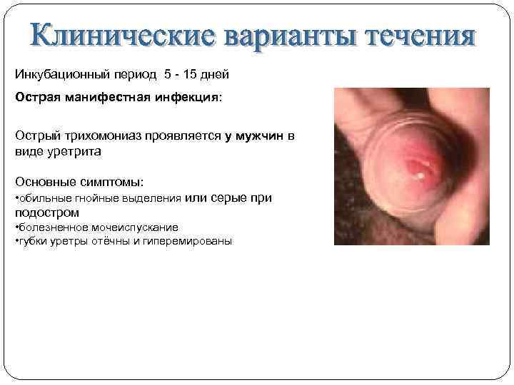 Инкубационный период 5 - 15 дней Острая манифестная инфекция: Острый трихомониаз проявляется у мужчин