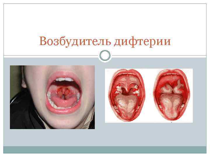 Возбудитель дифтерии 