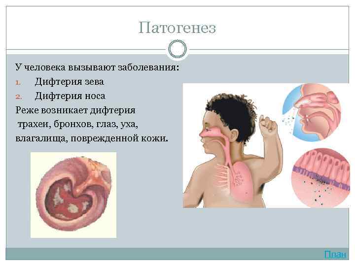 Патогенез У человека вызывают заболевания: 1. Дифтерия зева 2. Дифтерия носа Реже возникает дифтерия