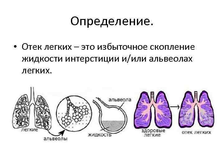 Определение. • Отек легких – это избыточное скопление жидкости интерстиции и/или альвеолах легких. 