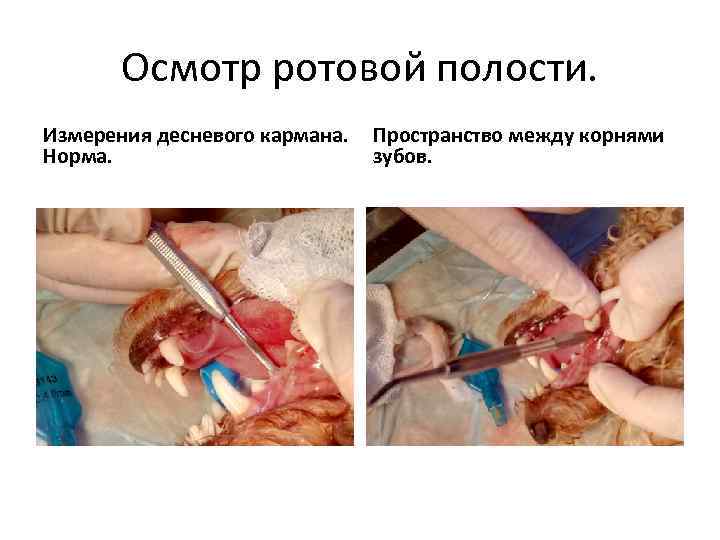 Осмотр ротовой полости. Измерения десневого кармана. Норма. Пространство между корнями зубов. 