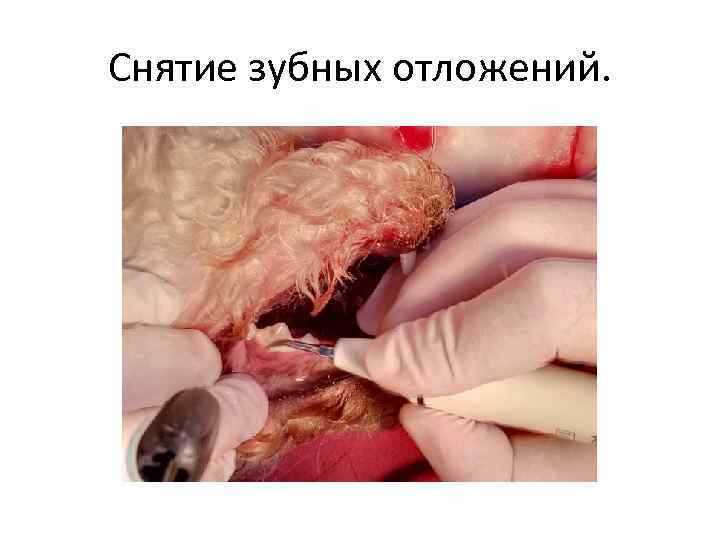 Снятие зубных отложений. 