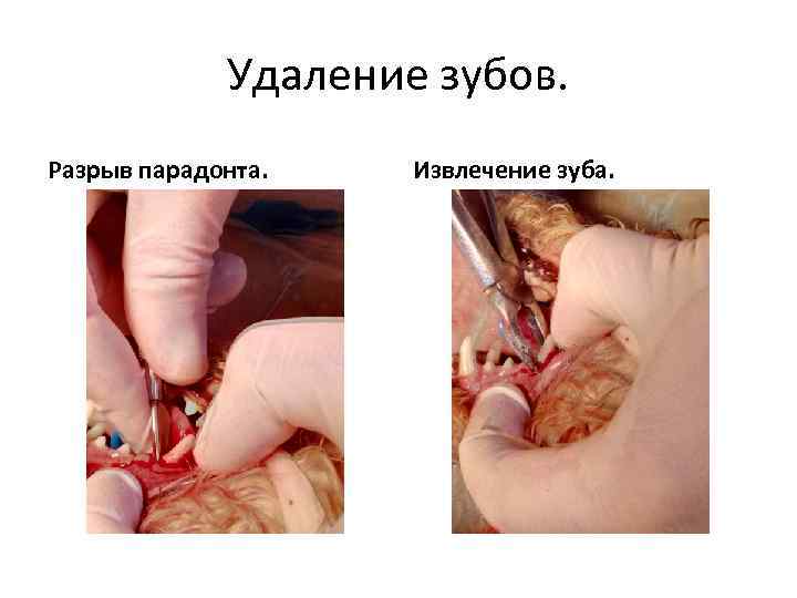 Удаление зубов. Разрыв парадонта. Извлечение зуба. 