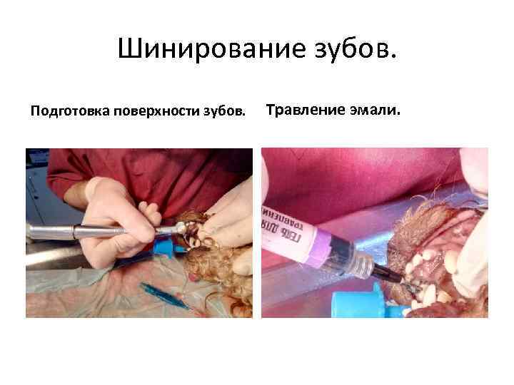 Шинирование зубов. Подготовка поверхности зубов. Травление эмали. 