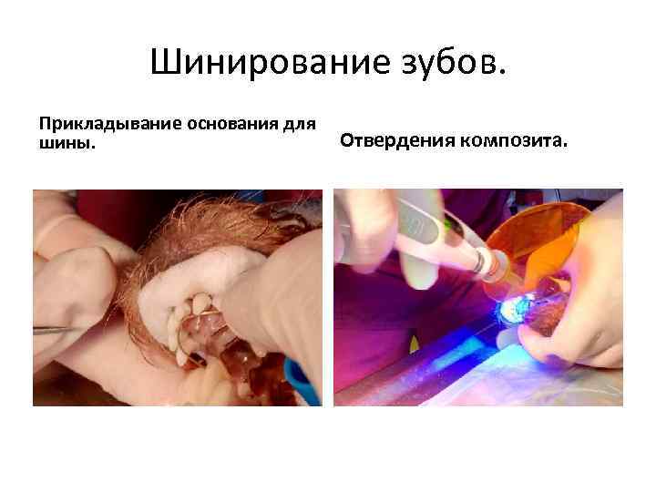 Шинирование зубов. Прикладывание основания для шины. Отвердения композита. 
