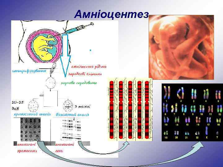 Амніоцентез 