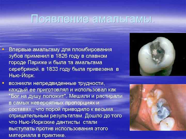 Появление амальгамы. § Впервые амальгаму для пломбирования зубов применил в 1826 году в славном