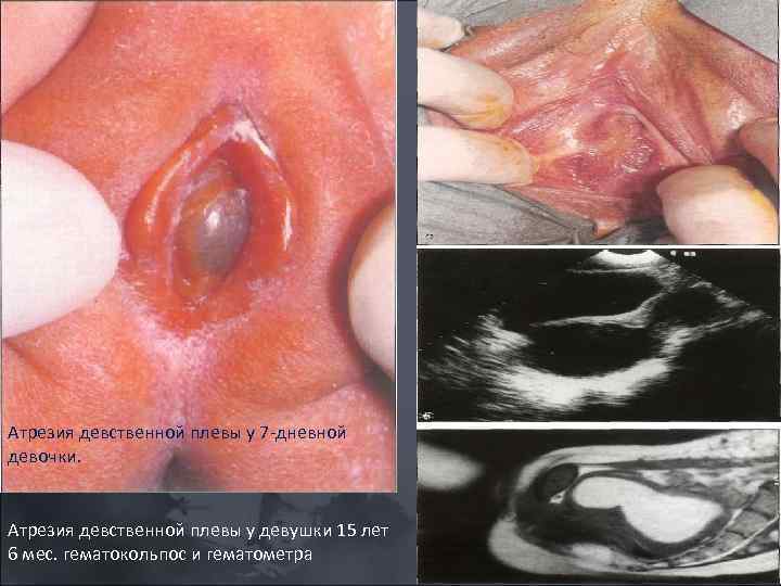 Атрезия девственной плевы у 7 дневной девочки. Атрезия девственной плевы у девушки 15 лет