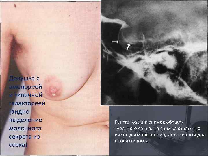Девушка с аменореей и типичной галактореей (видно выделение молочного секрета из соска) Рентгеновский снимок