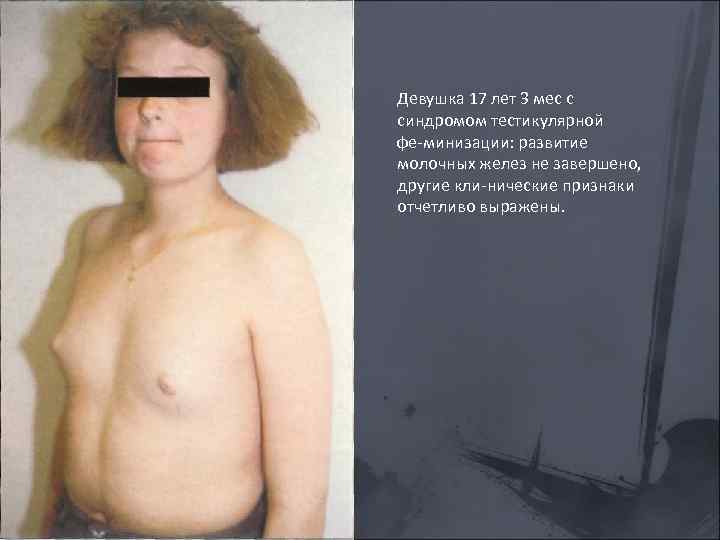 Девушка 17 лет 3 мес с синдромом тестикулярной фе минизации: развитие молочных желез не