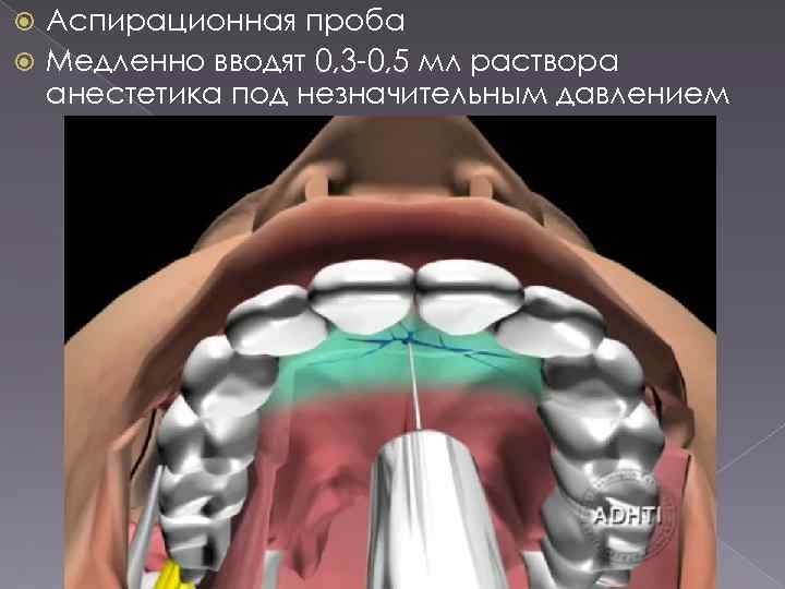 Аспирационная проба Медленно вводят 0, 3 -0, 5 мл раствора анестетика под незначительным давлением