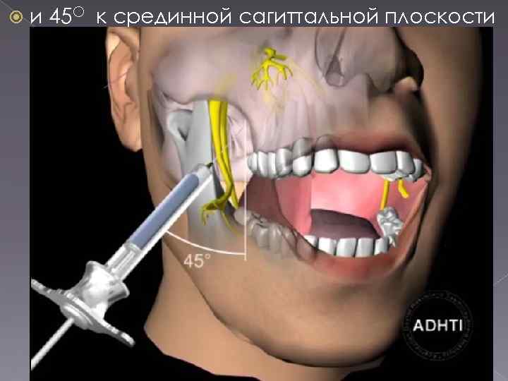  и 45 О к срединной сагиттальной плоскости 