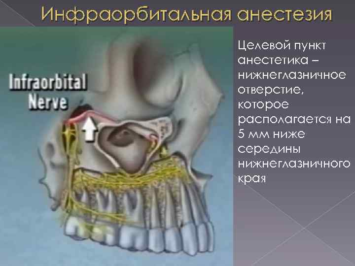 Инфраорбитальная анестезия Целевой пункт анестетика – нижнеглазничное отверстие, которое располагается на 5 мм ниже