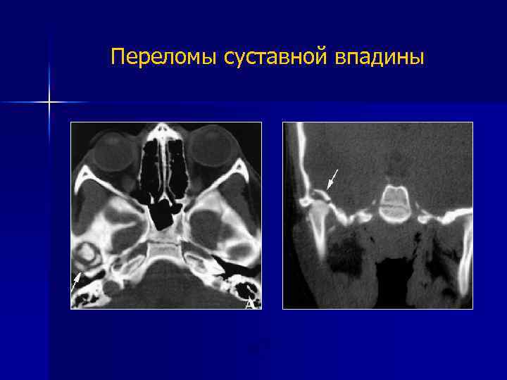 Переломы суставной впадины КТ 