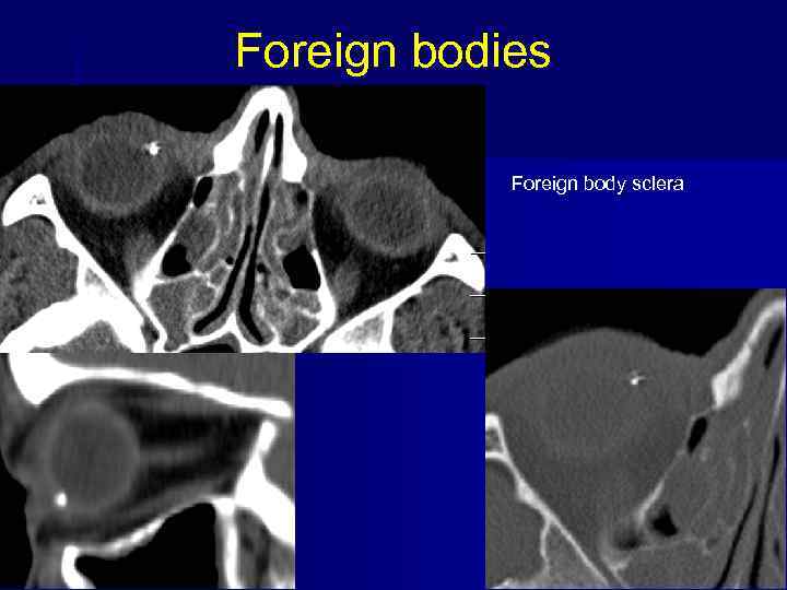 Foreign bodies Foreign body sclera 