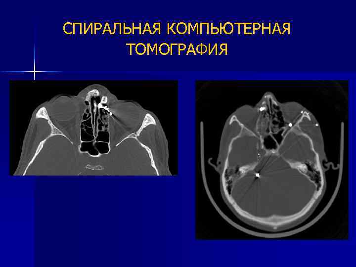 Скт что это. Спиральная томография. Спиральная компьютерная томограмма. Спирально компьютерная томография. СКТ томография это.