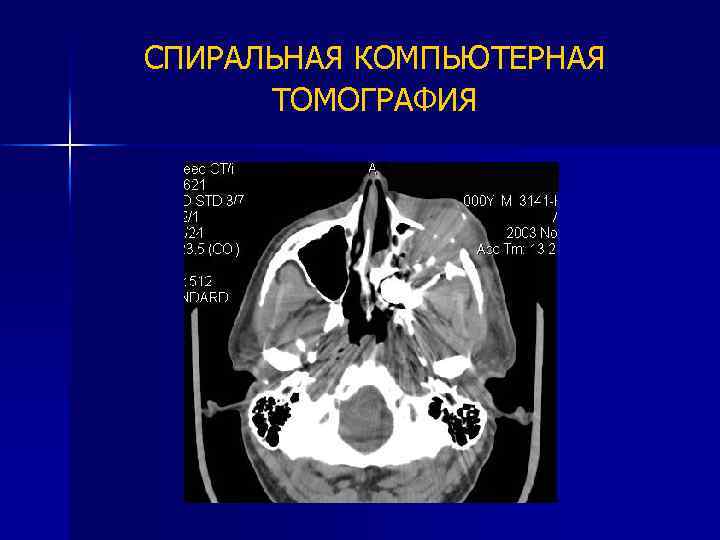 СПИРАЛЬНАЯ КОМПЬЮТЕРНАЯ ТОМОГРАФИЯ 
