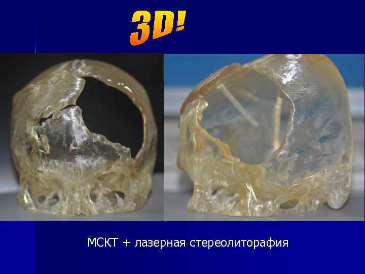 МСКТ + лазерная стереолиторафия 