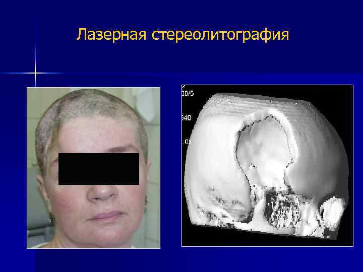 Лазерная стереолитография 