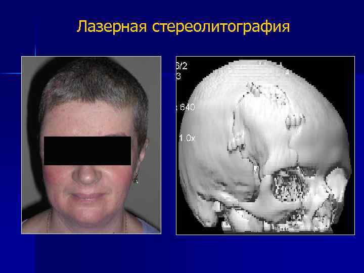 Лазерная стереолитография 