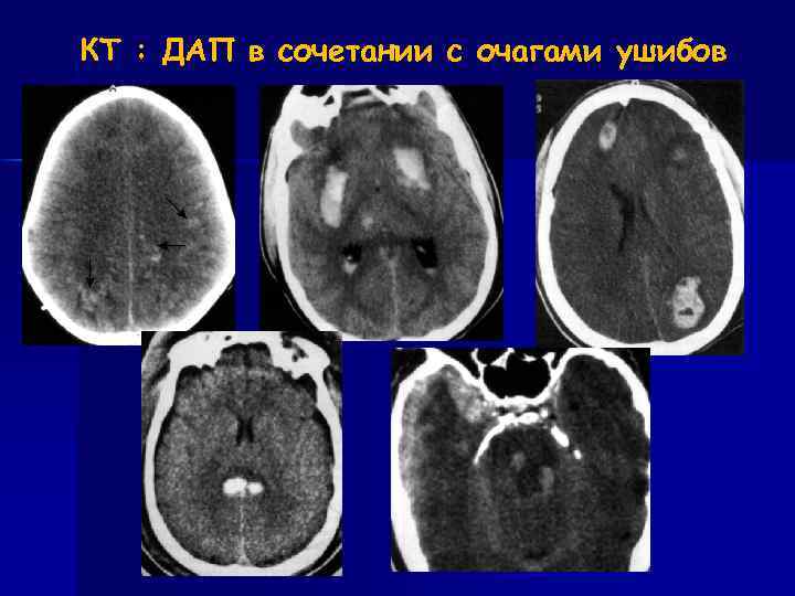 КТ : ДАП в сочетании с очагами ушибов 