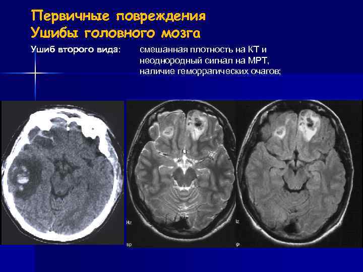 Ушиб головного мозга карта вызова