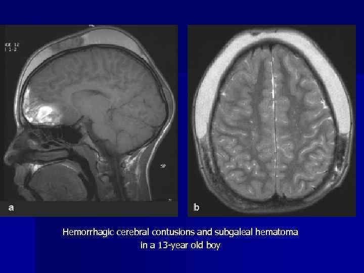 Hemorrhagic cerebral contusions and subgaleal hematoma in a 13 -year old boy 