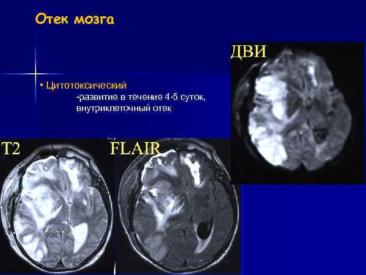 Отек головного мозга причины у взрослого. Цитотоксический отек головного мозга. Цитотоксический отек.