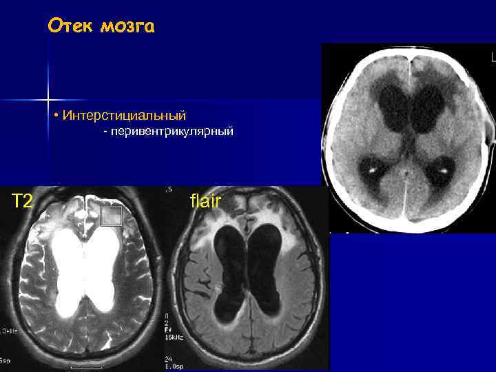 Мр картина перивентрикулярной лейкопатии