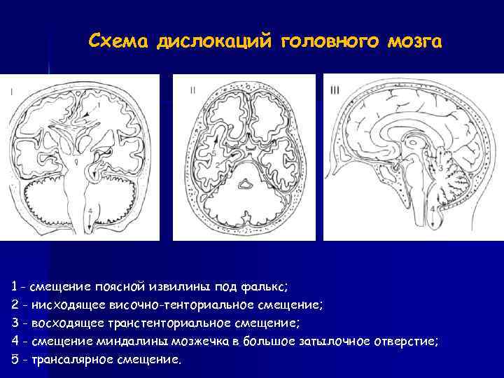 Схема дислокаций головного мозга 1 - смещение поясной извилины под фалькс; 2 - нисходящее