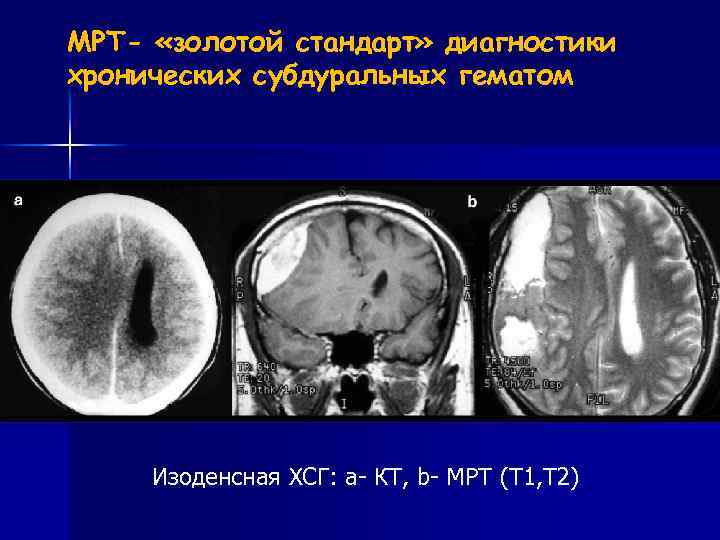 МРТ- «золотой стандарт» диагностики хронических субдуральных гематом Изоденсная ХСГ: а- КТ, b- МРТ (Т
