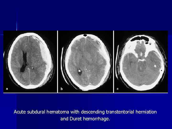 Acute subdural hematoma with descending transtentorial herniation and Duret hemorrhage. 