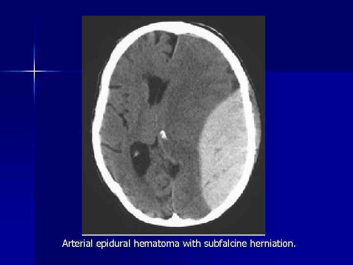 Arterial epidural hematoma with subfalcine herniation. 