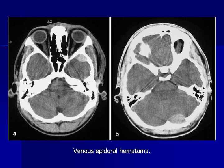 Venous epidural hematoma. 