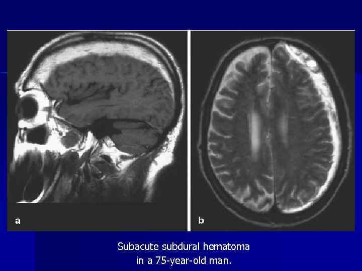 Subacute subdural hematoma in a 75 -year-old man. 