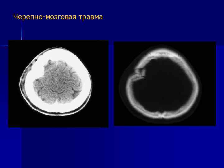 Черепно-мозговая травма 