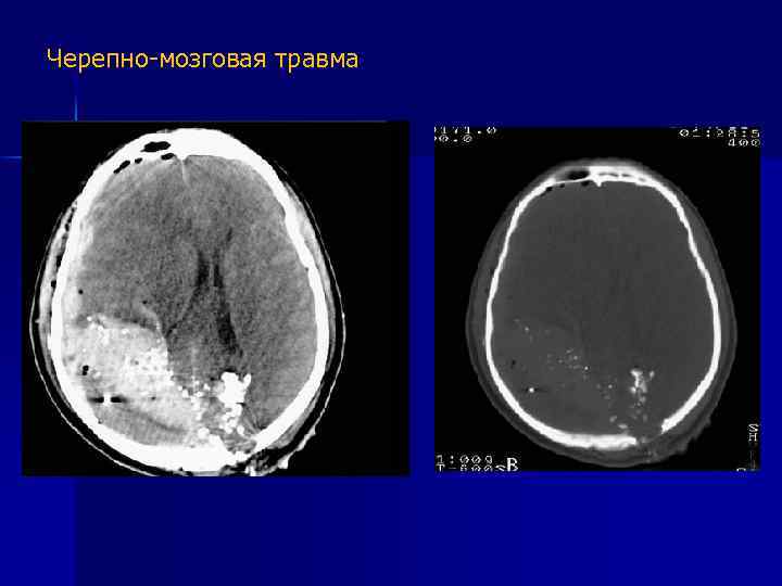 Черепно-мозговая травма 